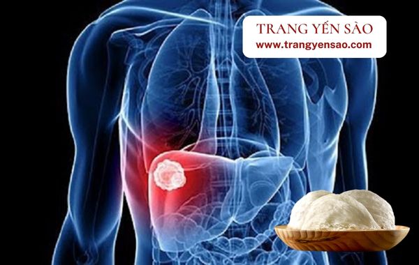 người bị ung thư gan có nên ăn yến sào